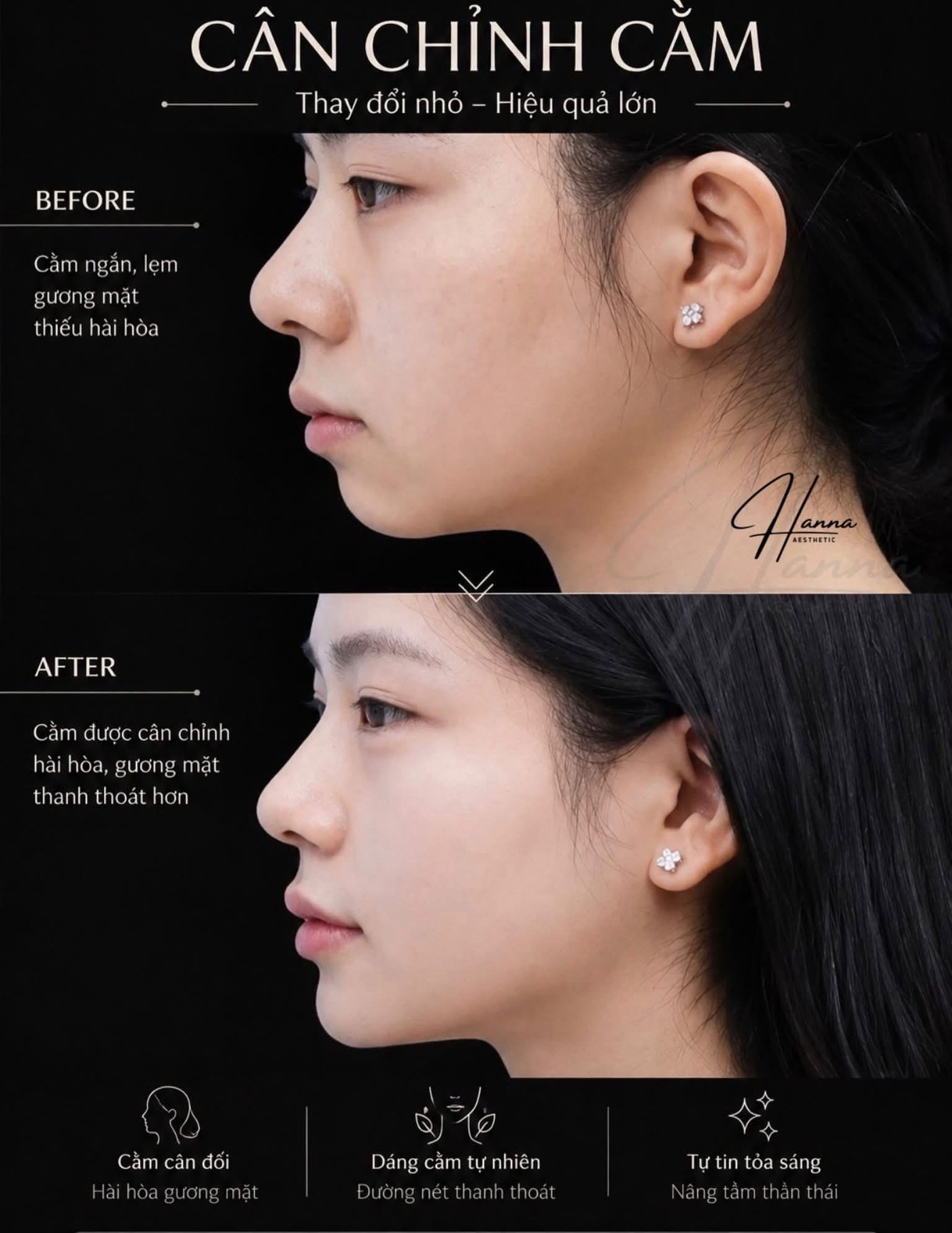 Case thực tế cân chỉnh cằm: trước và sau