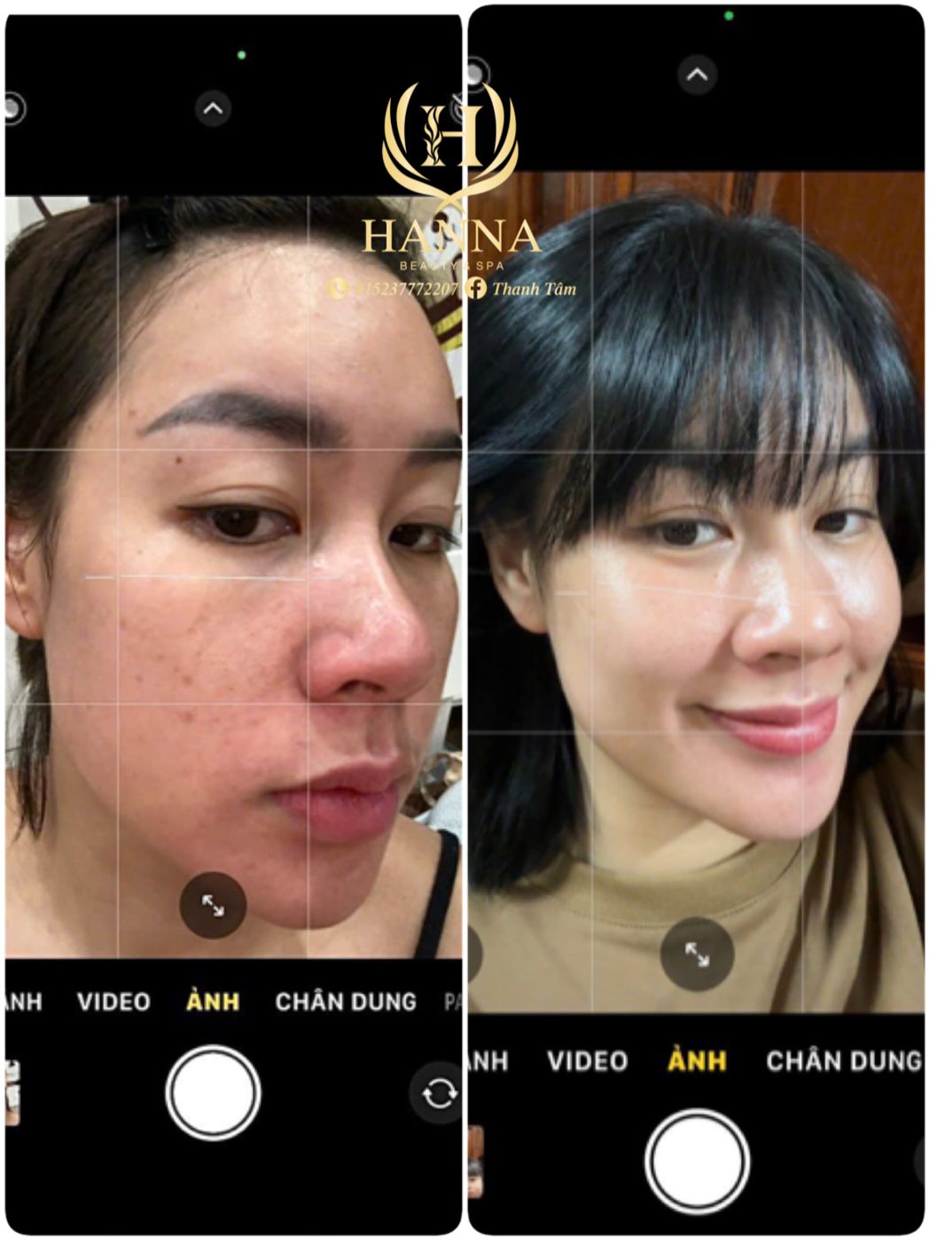Da đỏ, thâm và lỗ chân lông, sau liệu trình da rạng rỡ