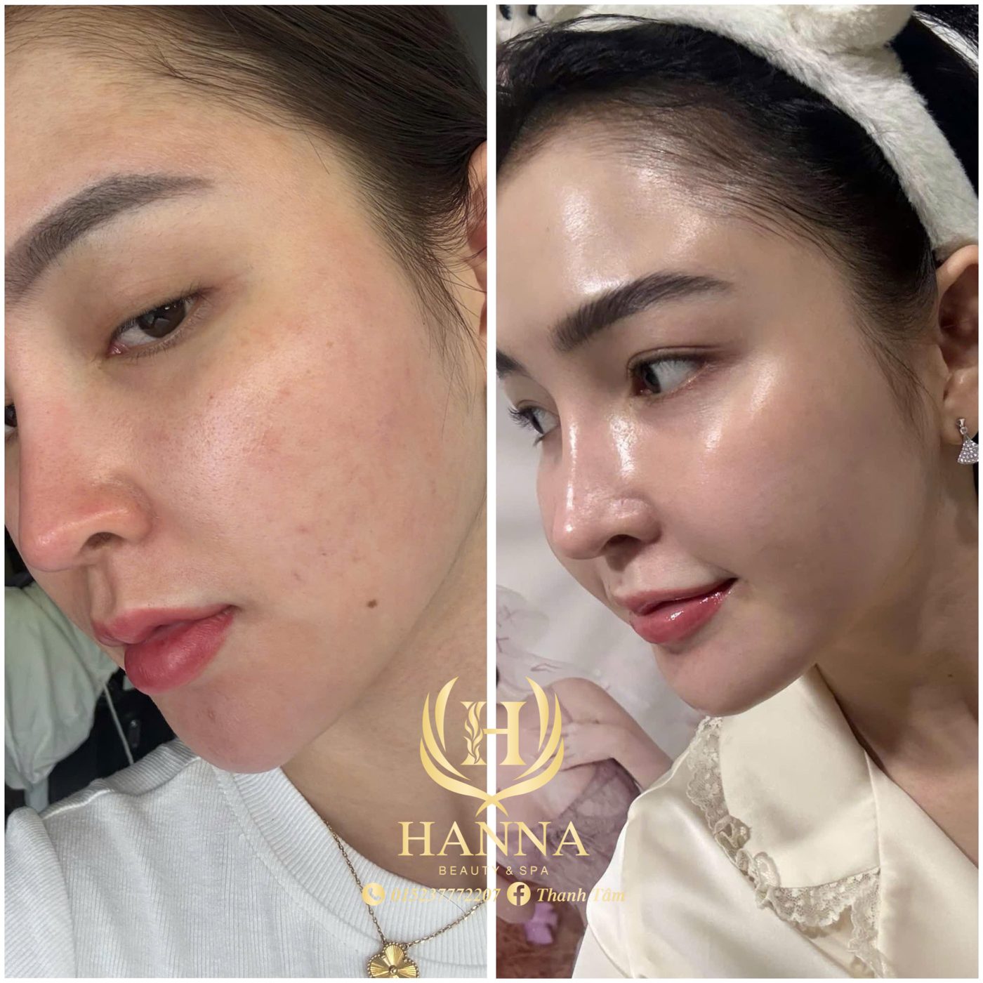 Da đỏ và lỗ chân lông to, sau liệu trình da căng mọng