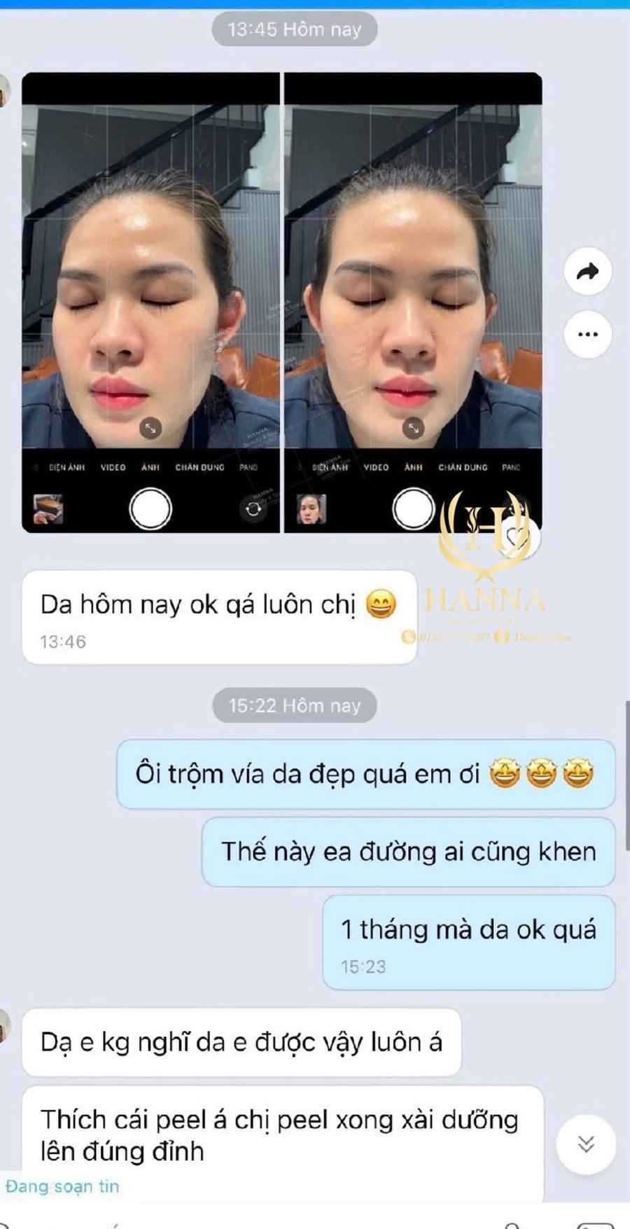 Khách gửi ảnh da sau 1 tháng: da hôm nay ok quá, thích peel