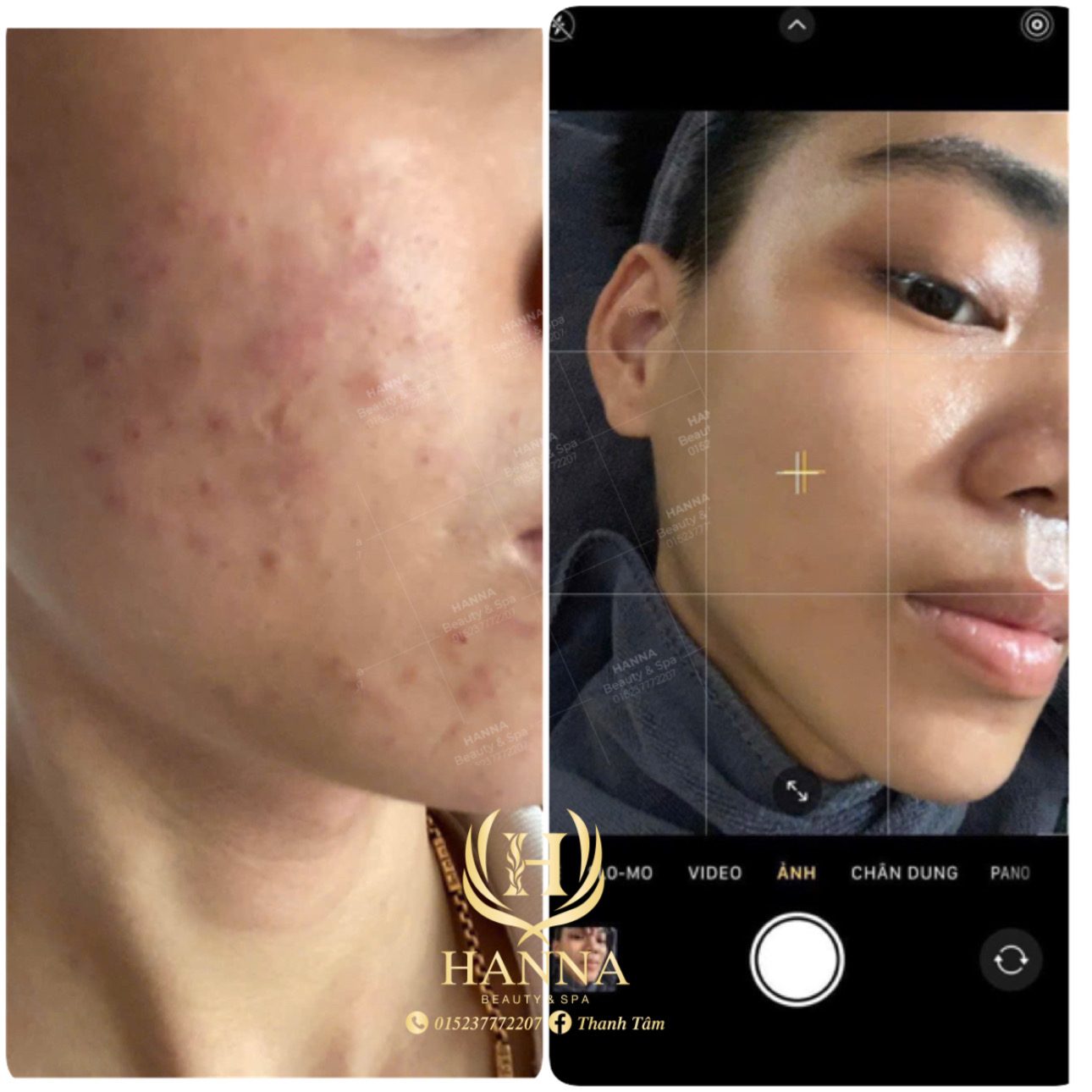 Mụn ẩn và mụn viêm vùng má, sau liệu trình da mịn