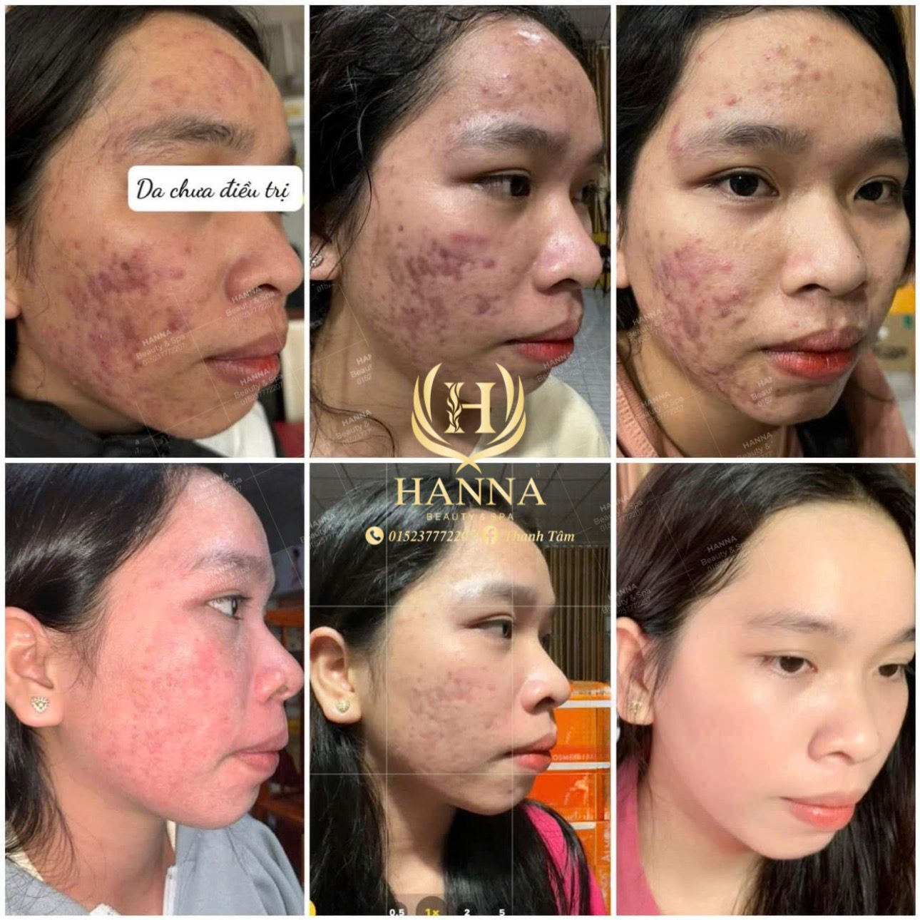 Da mụn viêm nặng và thâm đỏ, theo dõi qua từng giai đoạn điều trị