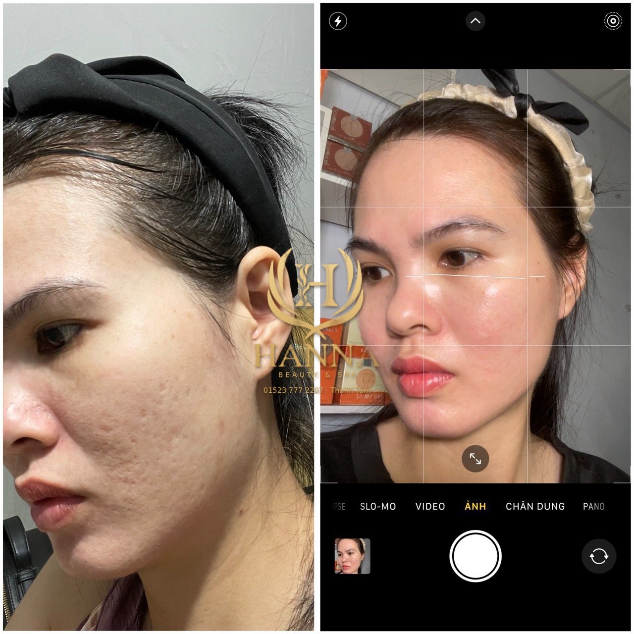 Kết quả điều trị sẹo rỗ và lỗ chân lông