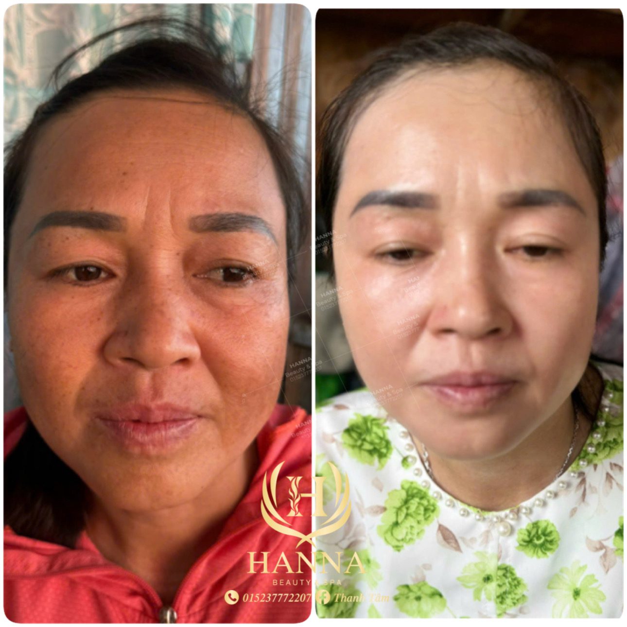 Da sạm, không đều màu, sau liệu trình da sáng hơn