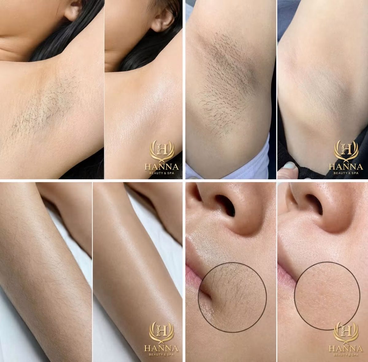 Triệt lông nách, tay và ria mép: trước và sau liệu trình