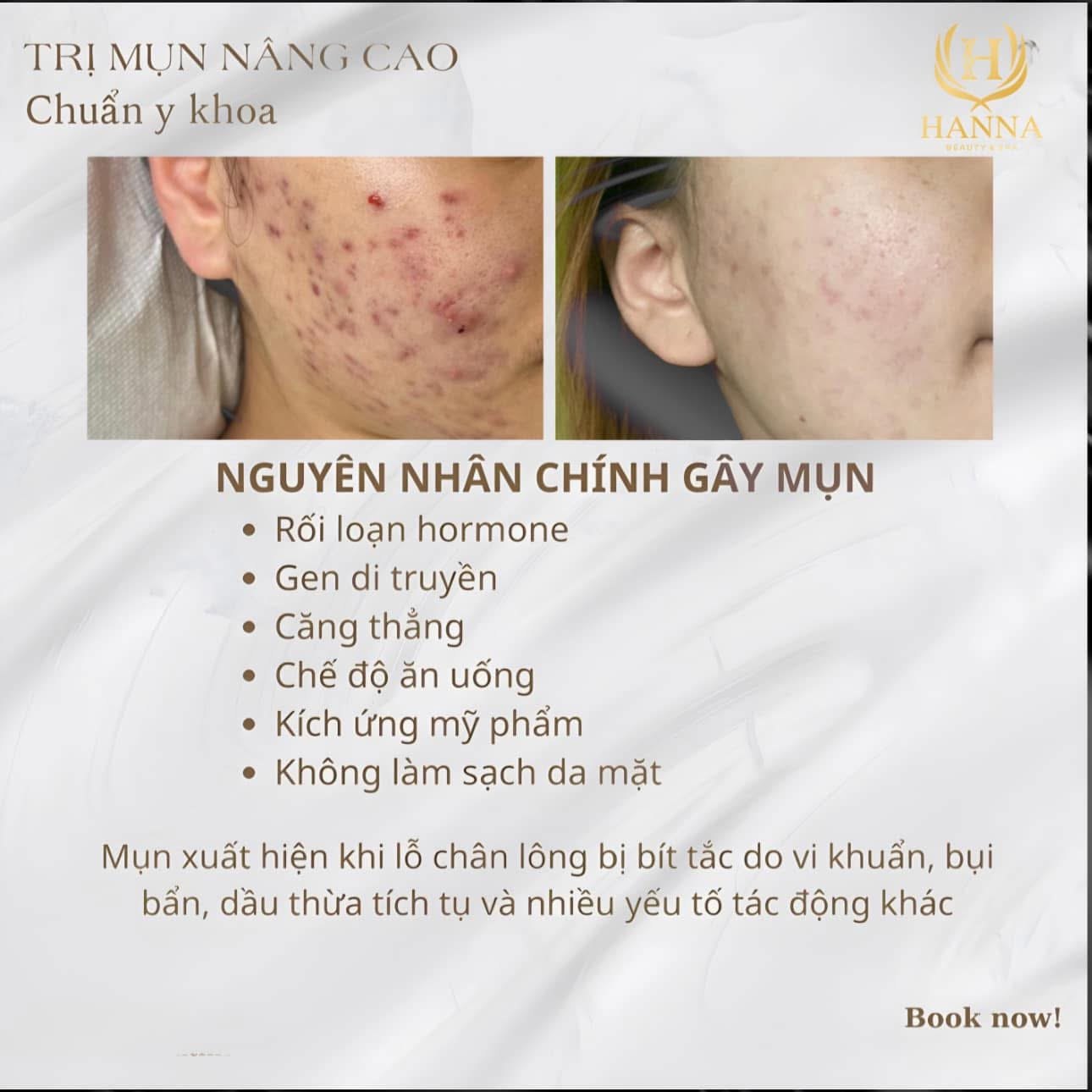 Trị mụn nâng cao chuẩn y khoa: da mụn viêm trước và sau điều trị